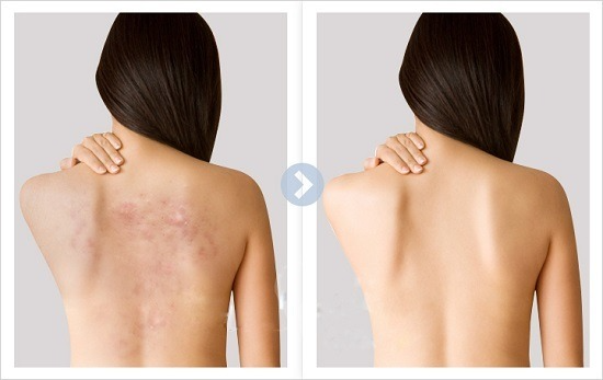 Combo tri mun naturae - trước sau