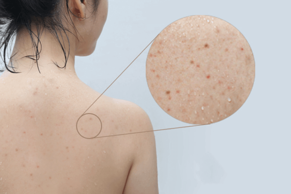 Vậy xà phòng trị mụn lưng cho nữ da dầu cần có những đặc điểm gì Và tại sao Naturae lại là lựa chọn hàng đầu cho làn da khó tính này