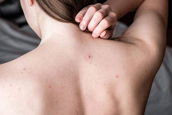 nguyên nhân gây mụn lưng