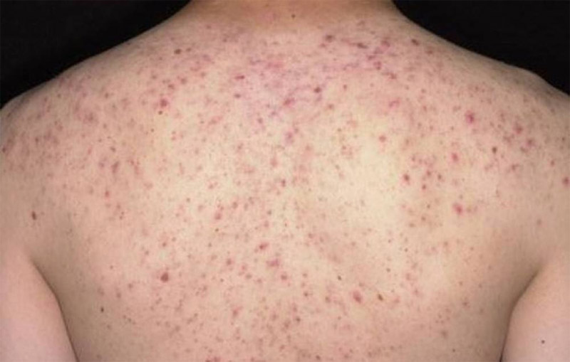 Xà Phòng Trị Viêm Nang Lông Tay Chân